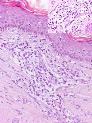 Imagen histológica de una de las lesiones de la espalda teñida con hematoxilina-eosina. Se observa un infiltrado linfoplasmocitario perivascular, con hiperqueratosis epidérmica (×20). El detalle muestra que el infiltrado se compone principalmente de células plasmáticas maduras (×40).