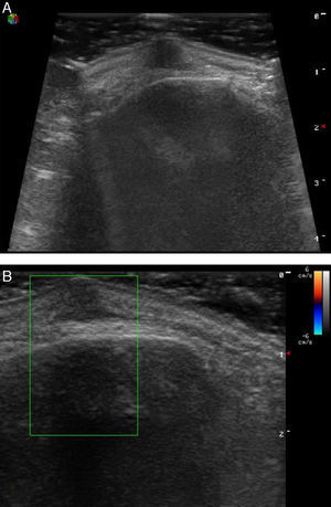 A. Modo B: lesión hipoecoica, regularmente delimitada, sin refuerzo ni sombra acústica posterior, localizada en la dermis, sin afectar al hueso. B. Doppler color: no identificó vascularización en el interior ni en la periferia del tumor.