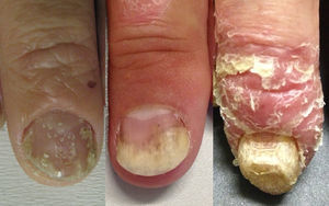 Clinical manifestations of nail psoriasis.
