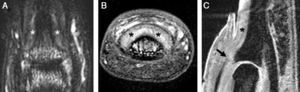 Magnetic resonance imaging of a distal interphalangeal (DIP) joint of a 29-year-old female with a 3-year history of psoriatic arthritis affecting the joint: (A) T2-weighted fat-suppressed coronal image of the dorsal DIP joint showing high signal around the joint and adjacent to the distal phalanx near the nail bed (denoted by asterisk). (B) T1-weighted fat-suppressed post-gadolinium axial image of the same joint showing enhancement and thickening of the tissues under the nail bed (denoted by asterisk). (C) Water-selective excitation sagittal sequence of the joint demonstrating the thickened tissues under the nail bed (denoted by asterisk) and an abnormal extensor tendon enthesis, which was thickened and showed loss of the low signal (arrow). Linear regions with low signal similar to the extensor tendon could be seen enveloping the nail (arrowheads). These may correspond to fibers from the extensor tendon extending toward the nail bed.