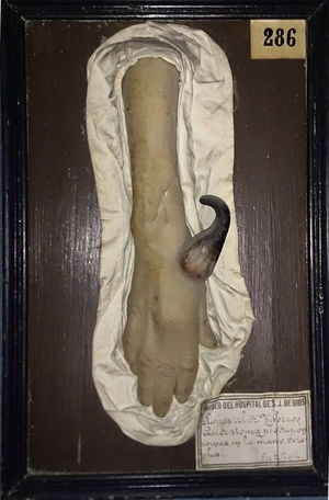 Figura con queratoma.