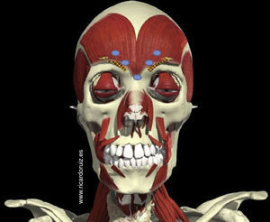 Clásicos 5 puntos de inyección para tratar la zona glabelar. Pretendiendo inyectar el músculo corrugador, en muchos casos lo que en realidad se está inyectando es la porción inferior del músculo frontalis, lo cual produce un descenso de la porción medial de las cejas y, en compensación, una elevación no natural de la cola de la ceja, lo cual genera la mirada en «Mefisto».
