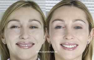 En estas fotografías se puede apreciar una relajación de las patas de gallo, una elevación de las colas de las cejas y una mejoría de la sonrisa gingival.
