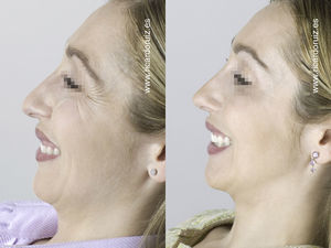 Lateralmente, se aprecia una mejoría de las patas de gallo, una elevación de la punta nasal y una mejor definición de la línea mandibular.
