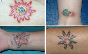 A. Lesión número 1 con inflamación de las áreas rojas de un tatuaje multicolor. B. Lesión número 3 con ulceración e inflamación coincidiendo con el color rojo de un tatuaje verde y rojo. C. Lesión número 4 que muestra una úlcera de gran tamaño en las zonas rojas de un tatuaje verde, rojo y negro. D. Lesión número 5 con inflamación del área roja de un tatuaje, iniciada 5 meses después de presentarse la lesión número 4 en la misma paciente.