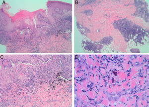 Estudio histológico de las lesiones de reacción granulomatosa a tatuaje. Se observan granulomas en la dermis superficial (A: hematoxilina-eosina ×4) y profunda (B: hematoxilina-eosina ×4). A mayor aumento se observan granulomas a cuerpo extraño alrededor del pigmento (C: hematoxilina-eosina ×10) y células fagocíticas rellenas de pigmento rojo (D: hematoxilina-eosina ×40).
