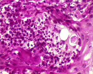 Histopatología: esporas micóticas de pared birrefringente y exoesporulación, ofrecen el aspecto de «timón de barco» (PAS ×40).