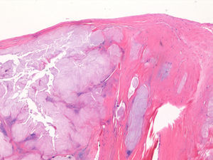 Estudio histológico. Hematoxilina-eosina: tejido fibrotendinoso con cartílago maduro (aumento ×10).