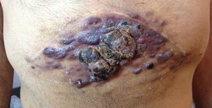 Múltiples tumores eritematovioláceos, de 2-3 cm de eje mayor, confluentes en una placa preesternal de 15 x 30 cm.
