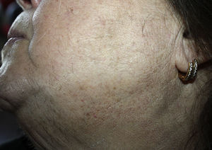 Hirsutismo a nivel del mentón y de las regiones laterales de la cara y del cuello.