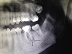La ortopantomografía mostró una imagen radiolúcida apical que engloba la raíz posterior del primer molar izquierdo.