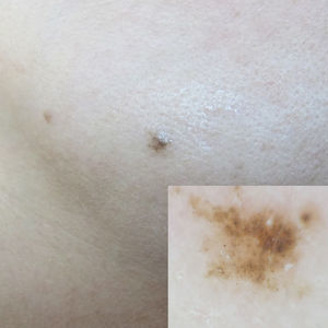 A. Pápula pigmentada en la mejilla izquierda. B. Estructuras redondeadas marrón claro, marrón oscuro y grisáceas por dermatoscopia.