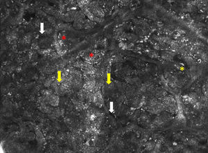 Imagen de microscopia confocal de 0,75×1mm. Se observaron nidos de células tumorales (flechas amarillas) con áreas oscuras de separación entre los nidos y el estroma (flechas blancas). Se observaron células reflectantes dentro (asterisco rojo) y fuera de los nidos (asterisco amarillo).