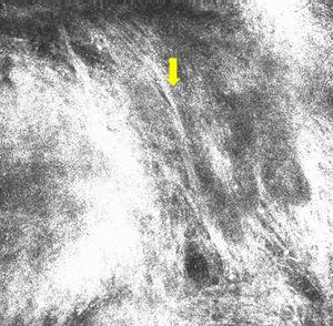 Imagen de microscopia confocal de 0,5×0,5mm. Se observó polarización de núcleos en epidermis (flecha amarilla).