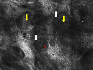 Imagen de microscopia confocal de 1×0,75mm. Se observaron nidos celulares (flecha amarilla y separación entre el estroma y los nidos [flecha blanca]). Puede observarse empalizada periférica en algunos nidos tumorales (asterisco rojo)
