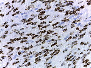 Expresión intranuclear del virus herpes 8 (tinción inmunohistoquímica VHH-8, ×40).