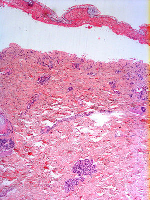 En el estudio histológico se aprecia una epidermis con necrosis confluente extensa y despegamiento a nivel subepidérmico. La dermis superior presenta un infiltrado linfoplasmocitario de predominio perivascular. (Hematoxilina-eosina 2,5X).