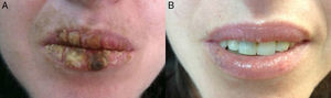 (a) Thick white-yellowish scales strongly attached to the lips of patient #1 before treatment. (b) Resolution of lesions after treatment with topical tacrolimus.