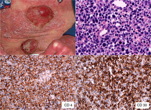 A: Micosis fungoide en fase tumoral. B: Detalle de la biopsia de una lesión tumoral en la que se aprecia un infiltrado linfoide difuso de célula grande en dermis (HE, ×400). C: Tinción inmunohistoquímica que demuestra predominio de linfocitos T CD4+ (CD4, ×400). D: Expresión del antígeno CD30 en las células del infiltrado linfoide (CD30, ×400).