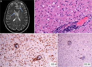 A: Alteración difusa de la señal de la sustancia blanca, especialmente a nivel frontal y periventricular (flechas). B: Biopsia de tejido cerebral que muestra un infiltrado linfoide de predominio perivascular (HE, ×200). C: Tinción inmunohistoquímica que pone de manifiesto el infiltrado linfocitario CD4+ en tejido cerebral (CD4, ×100). D: Expresión del antígeno CD30 en escasas células linfoides del tejido cerebral (CD30, ×40).