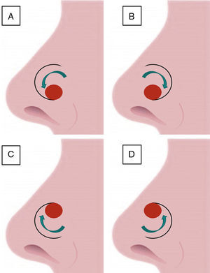Pedículo superior: A) Rotación lateral. B) Rotación medial. Pedículo inferior: C) Rotación lateral. D) Rotación medial.