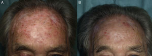 Varón en tratamiento con hidroxiurea con queratosis actínicas grado ii y iii en la frente, previamente tratado con crioterapia, (A) antes y (B) 3 meses después de TFDLD con MAL.