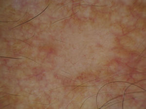 Dermatoscopia del caso 1: telangiectasias cortas, finas y poco ramificadas sobre un fondo perlado.