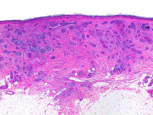Nidos de células basaloides en dermis en un estroma denso (hematoxilina-eosina, ×40).