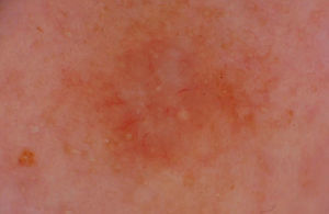Dermatoscopia del caso 2: vasos poco ramificados dispuestos en corona, con estrías blancas y seudoquistes de milium.