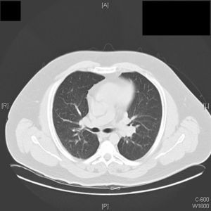 TAC de alta resolución con una reducción significativa de los nódulos pulmonares y adenopatías parahiliares transcurridos 6 meses desde el diagnóstico y tras la interrupción del tratamiento con anti-TNF.