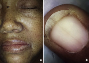 a) Imagen izquierda, máculas hiperpigmentadas en cara, labio superior e inferior. b) Imagen derecha, melanoniquia en mano, visión dermatoscópica.