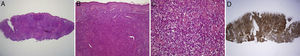 A y B. Biopsia que muestra el denso infiltrado linfocitario. Hematoxilina-eosina ×2 (A) y ×10 (B). C. Detalle de la composición del infiltrado mostrando el pleomorfismo celular. Hematoxilina-eosina ×40. D. Tinción inmunohistoquímica para CD4 ×2.