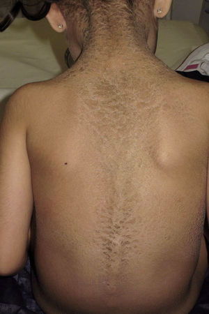Gruesas escamas oscuras en el dorso del tronco dibujando el trayecto vertebral.
