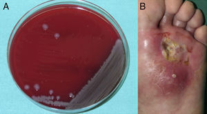 A) Crecimiento de colonias de Vibrio alginolyticus en medio agar sangre. B) Úlcera cutánea en planta del pie izquierdo sobre un área de radiodermitis crónica con formación de absceso.