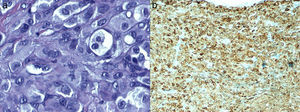 a) Pleomorfismo celular en área correspondiente al melanoma; en el centro, una figura mitótica (H&E, ×60); b) Expresión positiva citoplasmática difusa e intensa para MelanA (×40).