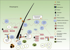 Factores predisponentes de HS.