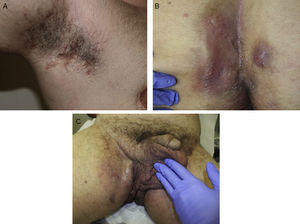 Varón de 36 años con HS grado iii. A. Lesiones lineales axilares infiltradas y dolorosas. B. Presencia de nódulos inflamatorios y abscesos supurativos en las nalgas. C. Presencia de abscesos que coalescen en la ingle derecha.