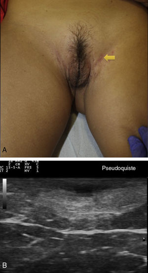 Hidradenitis supurativa. A. Imagen clínica de lesión papular inflamada. B. Imagen ecográfica de pseudoquiste inflamatorio.