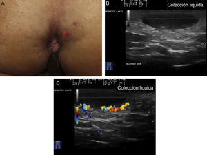 Hidradenitis supurativa. A. Imagen clínica de lesión nodular aparentemente anodina. B. Imagen ecográfica, que muestra la existencia de una colección fluida subyacente de importantes dimensiones. C. La función doppler muestra la elevada actividad inflamatoria de la lesión.