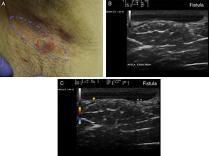 Hidradenitis supurativa. A. Lesión alargada eritematosa que ocupa la axila derecha. En rojo, el área clínicamente afecta. En azul, el área ecográficamente afecta. B. Imagen ecográfica que muestra la existencia de un trayecto fistuloso subyacente. C. La función doppler muestra una actividad inflamatoria leve.