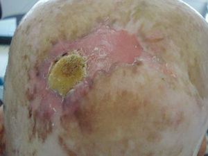Carcinoma epidermoide en cuero cabelludo sobre quemadura en la infancia.