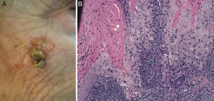 Imagen clínica de un CEC bien diferenciado en la región malar (A) e imagen histológica del mismo tumor (B) (hematoxilina-eosina×10).