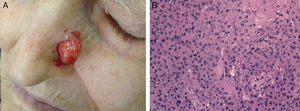 Imagen clínica de un CEC pobremente diferenciado en la pirámide nasal (A) e imagen histológica del mismo tumor (B) (hematoxilina-eosina×20).
