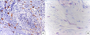 a)Infiltración del folículo por mastocitos (triptasa, ×100). b)Observación de elevado número de mastocitos en el corte realizado (azul de toluidina, ×100).
