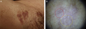 a) Placas hiperpigmentadas de superficie aplanada en la axila derecha. b) Imagen dermatoscópica de placa hiperpigmentada en la axila derecha donde se observa un patrón homogéneo blanco-azulado (círculo amarillo) con la presencia de glóbulos y puntos azul-grisáceos y líneas rojas de predominio periférico (círculo rojo). Dermalite II Pro-HR (10x).
