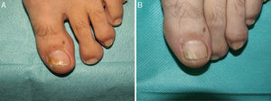 Onicomicosis subungueal distal y lateral por T. mentagrophytes. Antes (A) y 36 semanas después (B) de tratamiento con 3 sesiones, separadas por una semana, de terapia fotodinámica con metilaminolevulinato al 16% y Aktilite (Photocure ASA, Oslo, Noruega; 37J/cm2). Antes de cada sesión se realizó preparación con urea al 40% en oclusiva las 5 noches previas.