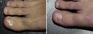 Onicomicosis blanca superficial por Fusarium oxysporum. Antes (A) y 48 semanas después (B) de tratamiento con 3 sesiones, separadas por una semana de terapia fotodinámica con metilaminolevulinato al 16% y Aktilite (Photocure ASA, Oslo, Noruega; 37J/cm2). Antes de cada sesión se realizó preparación con urea al 40% en oclusiva las 3 noches previas, y eliminación mecánica activa de lámina ungueal justo antes de la aplicación del fotosensibilizante.