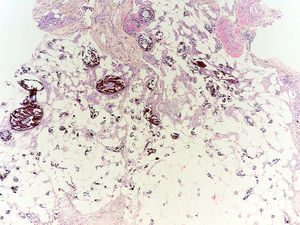Histología de calcinosis cutis. Biopsia que muestra en la dermis profunda y en el subcutis numerosos cúmulos de material cristalino y basófilo correspondiente a depósitos cálcicos (hematoxilina y eosina ×40) (cortesía de la Dra. Natalia Navas García).