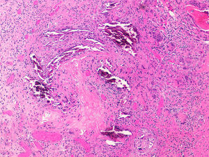 Biopsia que muestra depósitos de calcio en el contexto de un pilomatrixoma o epitelioma calcificante de Malherbe. Se observan islotes de células basofílicas acompañado de células fantasmas eosinófilas (hematoxilina y eosina ×100) (cortesía de la Dra. Natalia Navas García).