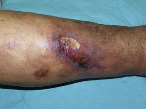 Úlcera cutánea acompañada de livedo racemosa secundaria a calcifilaxis.